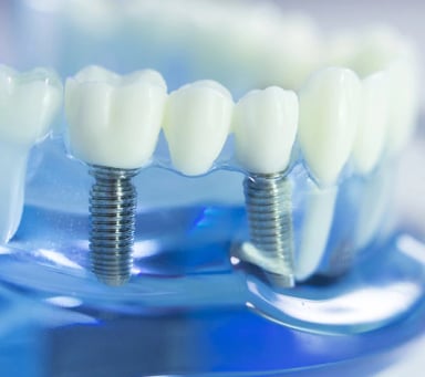 Close-up of dental implants showing metal screws and lifelike crowns.