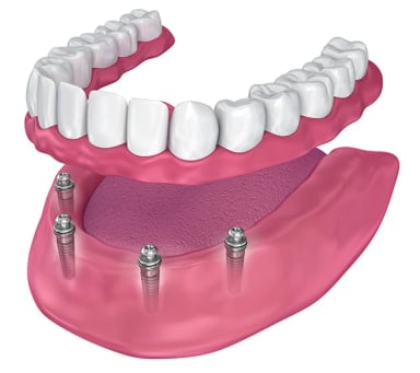 3D illustration of dental implants and prosthetic teeth