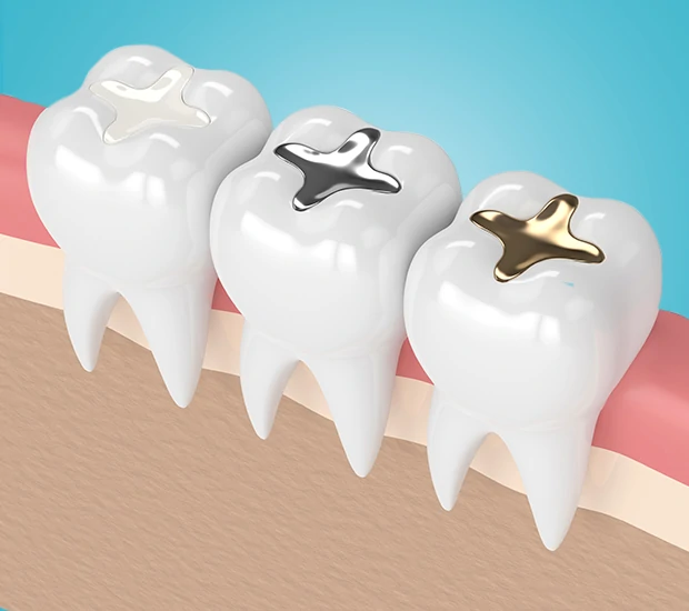 Close-up of dental crowns in dental gums