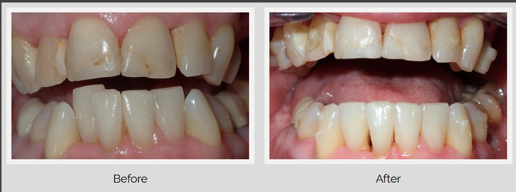 Before and after dental treatment comparison photo