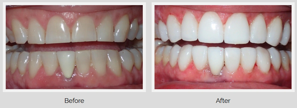 Before and after teeth whitening results