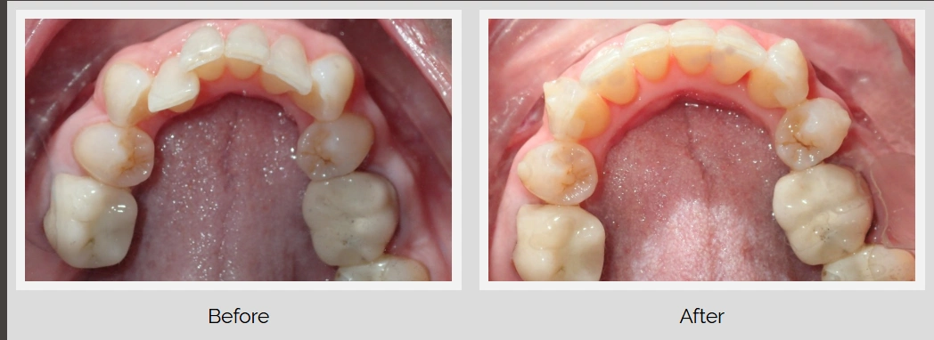 Comparison of dental alignment before and after treatment