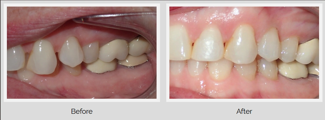 Dental treatment before and after comparison