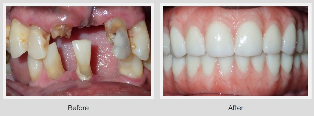 Comparative visual of dental restoration: before and after treatment.