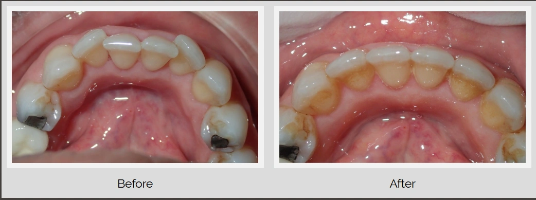Dental before and after comparison of a smile transformation