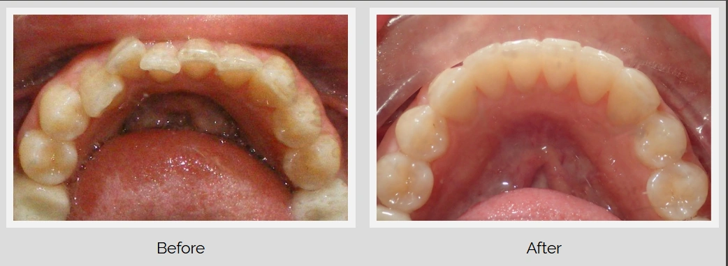 Dental before and after braces treatment