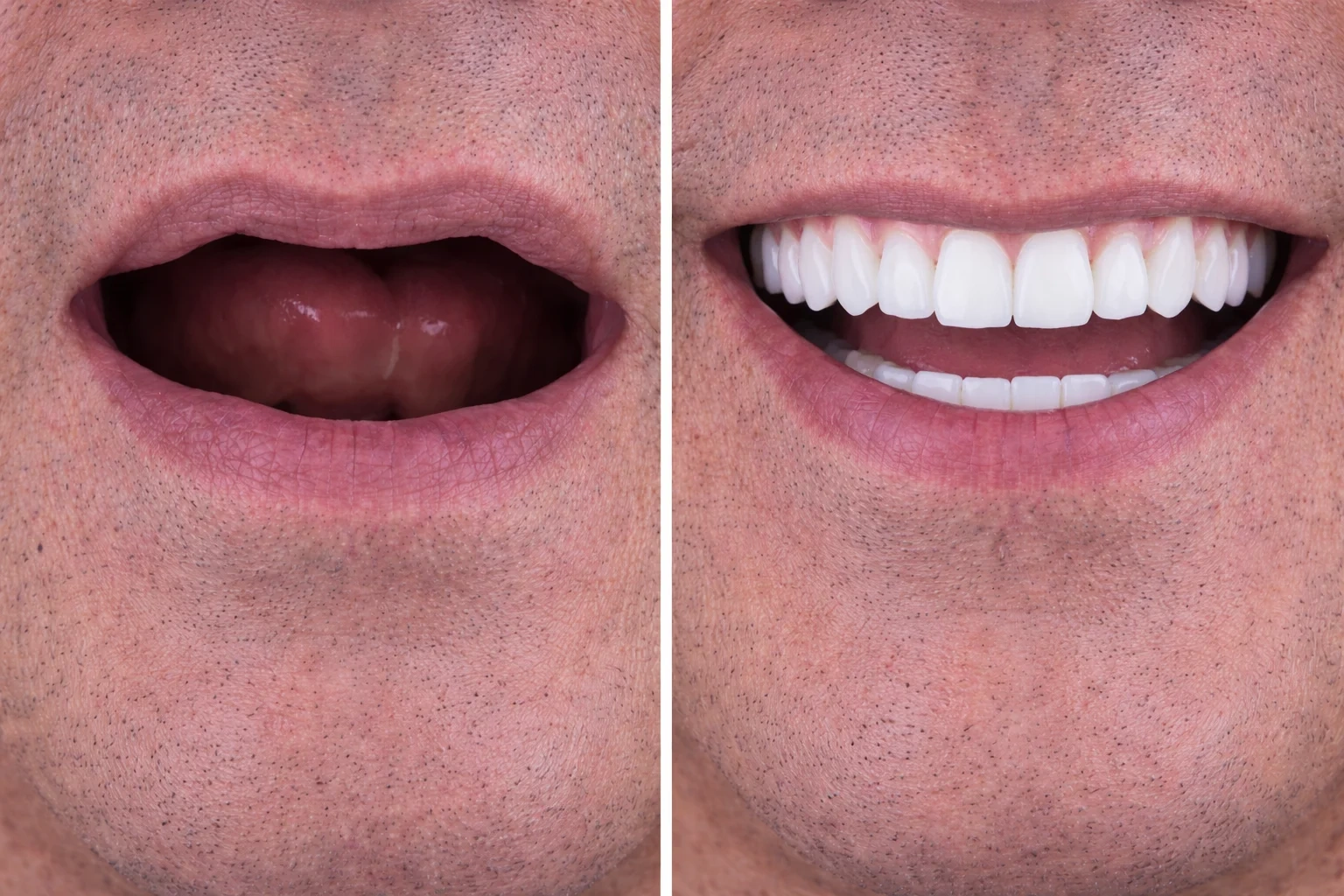 Before and after image of a person's smile.
