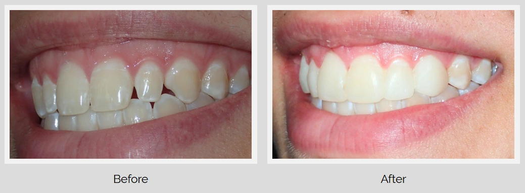 Before and after dental treatment showing teeth