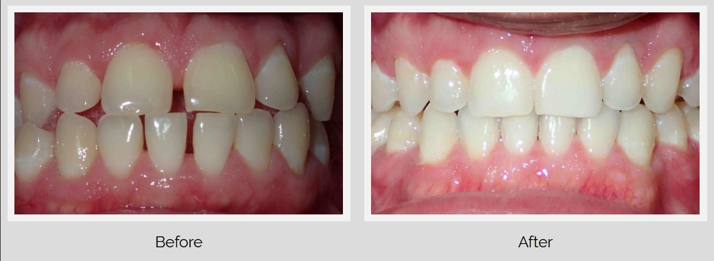 Before and after dental treatment showcasing teeth alignment and whitening